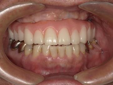 銀歯が目立つ治療前の様子
