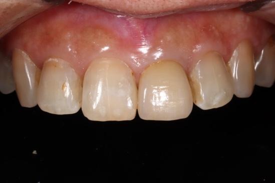 被せ物を装着した様子②