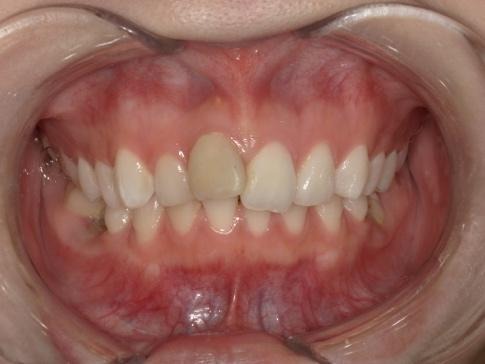 1本だけ黄色い前歯