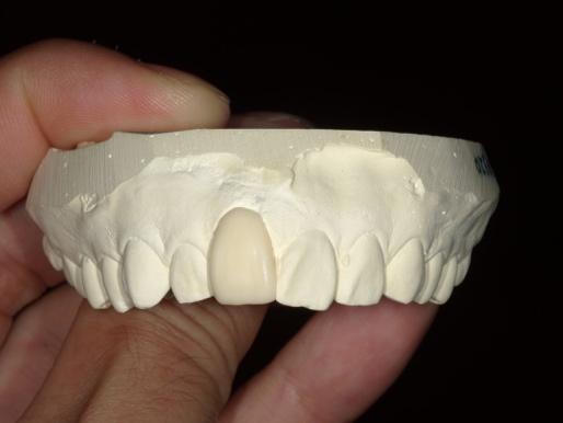 前から見た被せ物の模型